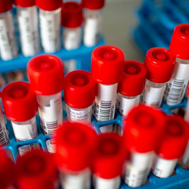 Koronavirüste vaka sayısı 10 milyonu, ölenlerin sayısı 500 bini aştı